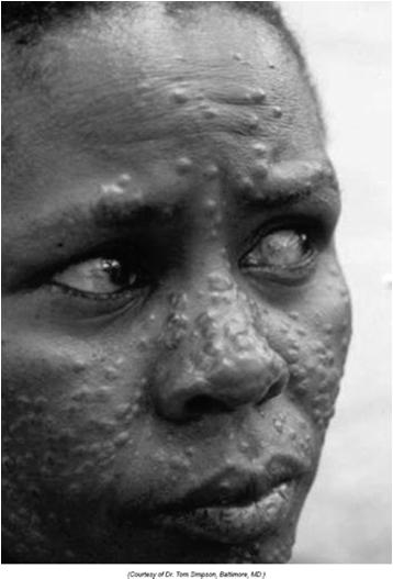 Σπλαγχνική λεϊσμανίαση Ειδικές μορφές ερματική λεϊσμανίαση μετά σπλαγχνική λεϊσμανίαση (PKDL) L. donovani Σουδάν: 50-60% εντός 6 μηνών μετά θεραπεία ΣΛ Ν.