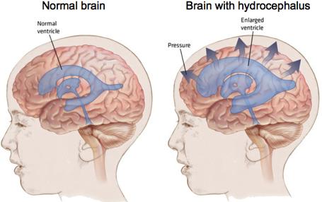Υδροκέφαλος Αύξηση της πίεσης