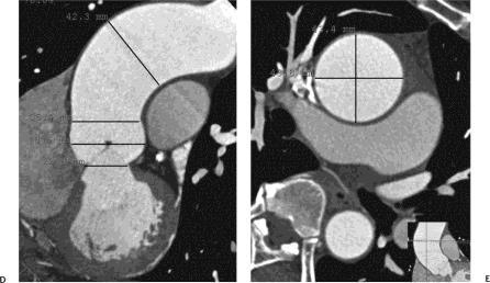 Υψηλό κόστος Σπινθηρογράφημα (PET) (20) (PET-positron emission tomography) Ανίχνευση φλεγμονής τοιχωμάτων Πίνακας 6: