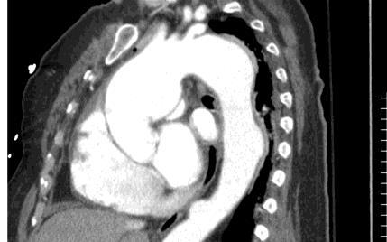 Πλεονεκτήματα/ TTE TOE CT MRI Αγγειογραφία Μειονεκτήματα Ευκολία χρήσης +++ ++ +++ ++ + Διαγνωστική αξιοπιστία + +++ +++