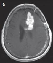 Ψευδοβελτίωςθ (pseudoresponse) μετά από κεραπεία με