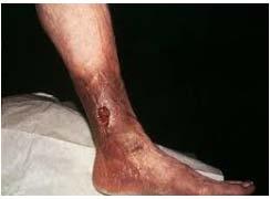 Αντιμετώπιση PTS Κάλτσες διαβαθμισμένης συμπίεσης (20 30 mm Hg ή