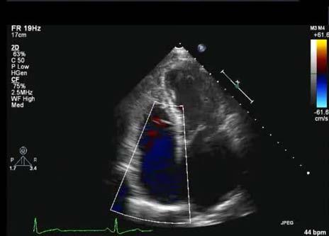 Διαθωρακικός υπέρηχος καρδιάς στο FU Όσοι είχαν επιβάρυνση δεξιάς κοιλίας/πυ: επανέλεγχος κατά την έξοδο Συνυπάρχουν συμπτώματα και παθολογικά ευρήματα: 3 μήνες Διαφορετικά: 3-6 μηνών ANMCO Position