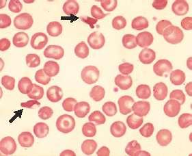 ΔΙΠΛΟΣ ΕΤΕΡΟΖΥΓΩΤΗΣ HbS/HbC Περιφερικό αίμα παρατηρούνται: ερυθροκυτταρικοί κρύσταλλοι δίκην