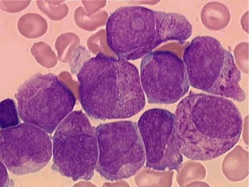 Άφθονα ραβδία Auer Συσσωματώματα από ραβδία Auer (faggot cells). Συχνά ΔΕΠ!