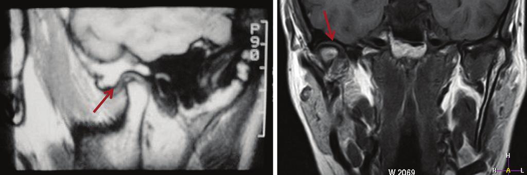 Γναθοπροσωπική απεικόνιση A B Εικόνα B24.18 Μαγνητική τομογραφία με κλειστό στόμα. A σε οβελιαία προβολή ο διάρθριος δίσκος διακρίνεται μετατοπισμένος μπροστά από τη κεφαλή του κονδύλου (βέλος).