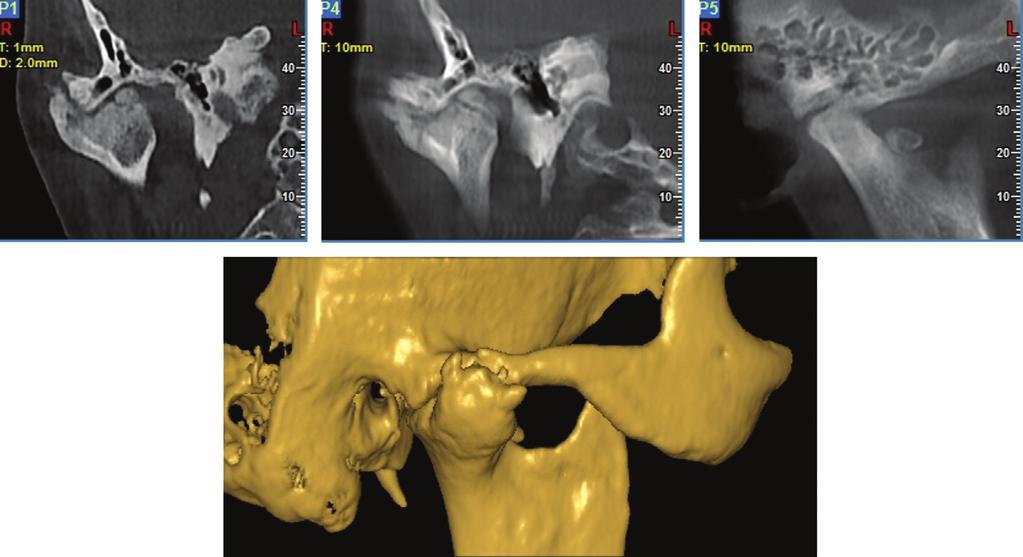 Γναθοπροσωπική απεικόνιση Εικόνα B24.33 Ασθενής με αγκύλωση δεξιάς ΚΓΔ μετά από τραυματισμό. Διαπιστώνεται έλλειψη του διαρθρίου χώρου και αντικατάσταση του με εναπόθεση οστίτου ιστού.