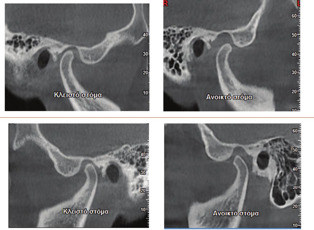 Γναθοπροσωπική απεικόνιση Α Β Εικόνα B24.42 Μαγνητική τομογραφία ασθενούς με πρόσθια μετατόπιση του δίσκου με ανάταξη.