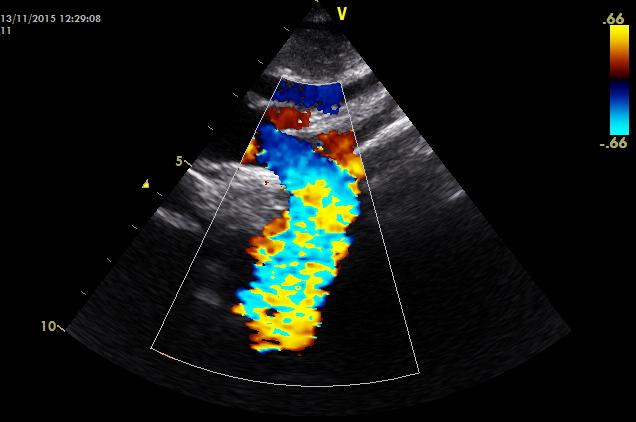 Υ/Γ μετά την 1 η αγγειοπλαστική AΠ: 120/80 mmhg