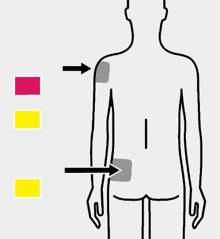 3 Χορηγήστε την ένεση Χορηγήστε την ένεση Δελτοειδής μυς ή Ροζ πλήμνη Κίτρινη πλήμνη Γλουτιαίος μυς Κίτρινη πλήμνη