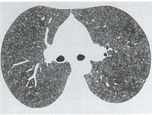 HP:Hypersensitivity pneumonia << Ιωση>>, μυαλγίες,αρθραλγίες.