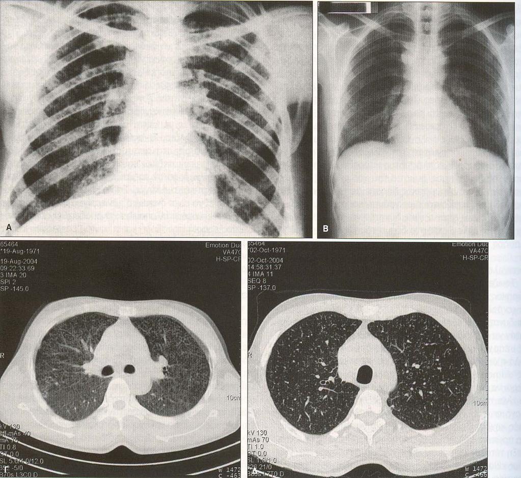 Κεχροειδής TBC: Κακουχία, πυρετός, ωχρότητα,