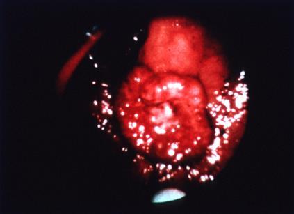 RECTAL CANCER Sigmoidoscopy All