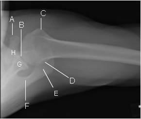 ουραιοκεφαλική προβολή (A) Κορακοειδής απόφυση (B) Γληνοβραχιόνια άρθρωση (C)Έλασσον όγκωμα (D)Οπισθοπλάγια επιφάνεια κεφαλής (E) Ακρώμιο (F) Άκανθα ωμοπλάτης (G)Γληνοειδής απόφυση (H)Βάση