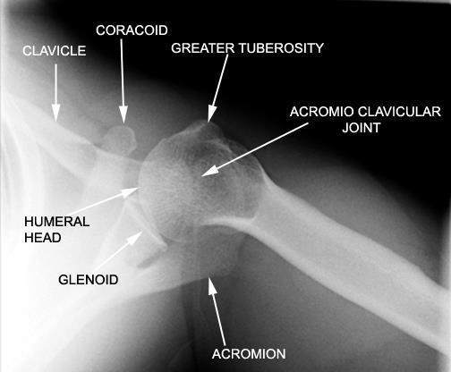 ουραιοκεφαλική προβολή glenoid: ωμογλήνη humeral head: κεφαλή βραχιονίου acromion: ακρόμιο coracoid: κορακοειδής