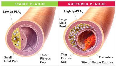 ΛΙΠΟΠΡΩΤΕΙΝΙΚΗ ΦΩΣΦΟΛΙΠΑΣΗ Α2 (Lp PLA2) Έχει παρατηρηθεί ότι