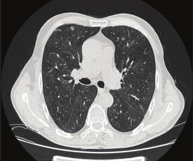acquired pneumonia, lymphomatoid granulomatosis, Wegener granulomatosis, lipoid pneumonia, sarcoidosis, pulmonary neoplasms, pulmonary infraction and following radiation and radiofrequency therapy of