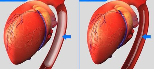 αριστερής κοιλίας, η αύξηση της καρδιακής παροχής και η ελάττωση του έργου της αριστεράς κοιλίας (μέχρι και 25%).