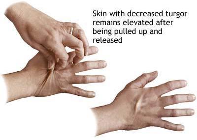 ΧΑΡΑΚΤΗΡΙΣΤΙΚΑ ΑΦΥΔΑΤΩΣΗΣ Σφυγμός: αυξημένος Αρτηριακή πίεση: μειωμένη Σπαργή δέρματος: