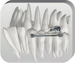 современа стоматологија CARRIERE DISTALIZER Сл.1. Приказ на Carriere distalizer апаратот Што е тоа Carriere distalizer и која е неговата намена?