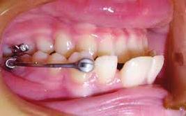 современа стоматологија Сл.2. Приказ на Carriere distalizer апаратот во уста на пациент Сл.3.