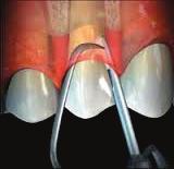 современа стоматологија Употреба на периоскоп во третманот на пародонталната болест Зошто периоскоп?