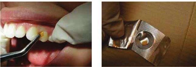 современа стоматологија пародоталните џепови. Оваа постапка може да се повтори на три или шест месеци од првичниот третман.