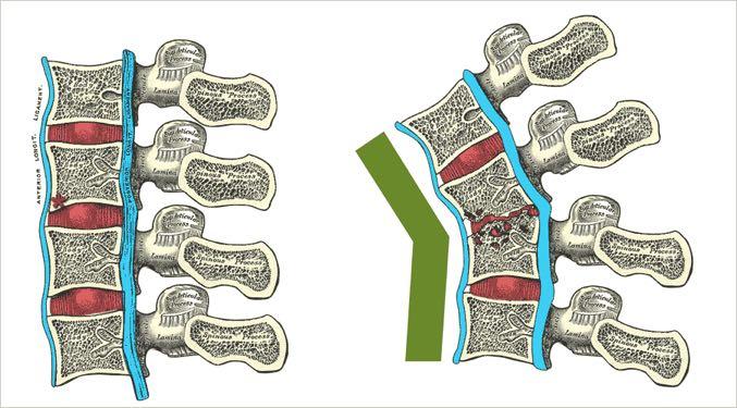 Καταστροφή των σπονδυλικών σωμάτων gibbus deformity