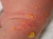 Panarițiu Impetigo stafilococic al