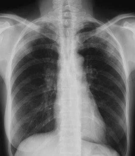 Idiopathic Chronic Eosinophilic Pneumonia (ICEP) 1. Respiratory symptoms of usually more than 2 weeks 2.