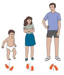 Βάδιση με έσω στροφή των ποδιών Η βάδιση με τα πόδια σε έσω στροφή είναι συχνή στην παιδική ηλικία και