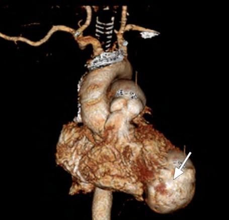 Method combining surgery with gadolinium-enhanced MR A novel method combining surgery with gadolinium-enhanced MR to construct a preoperative 3D systolic heart model was created.