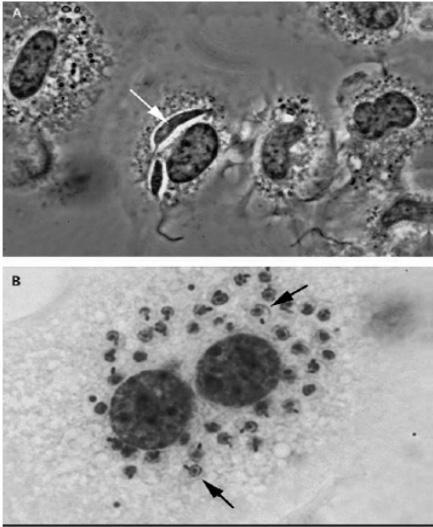 Λεϊσμανίαση Παθογόνο αίτιο Γένος: Leishmania Υπογένη Viannia (Κ. και Ν.