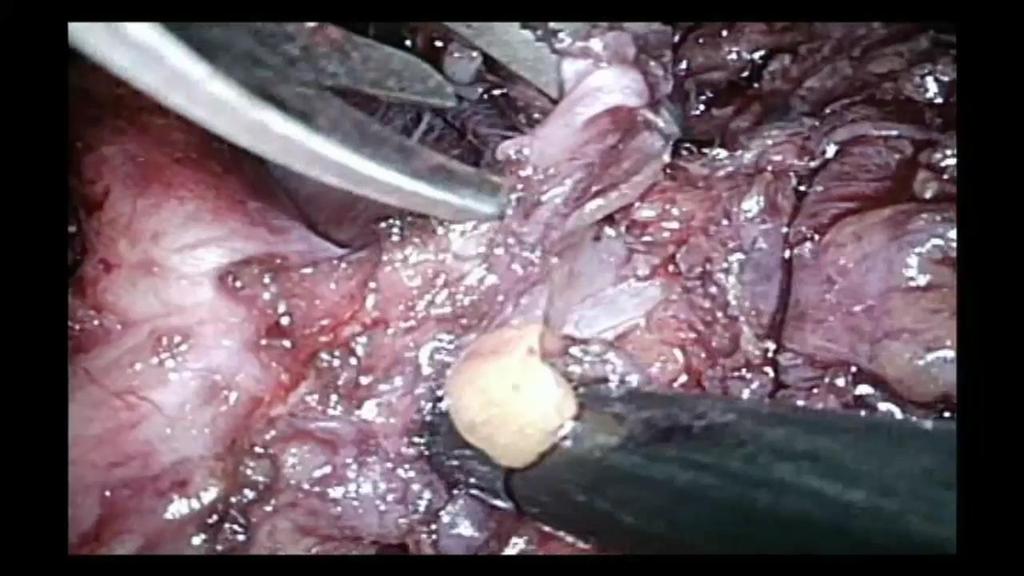 πίεσης σε 20mmHg Trendelenburg