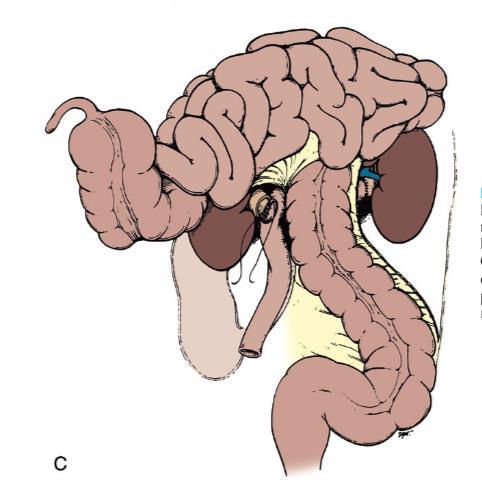 Tips&Tricks: Ileal Conduit Ileal