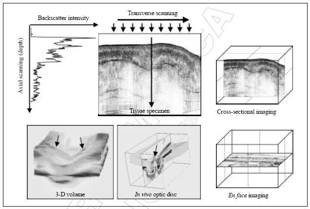 Οπτική Τομογραφία (Optical Coherence Tomography, OCT) Η οπτική τομογραφία δημιουργεί εικόνες της μικροδομής ενός ιστού σε τομές, σε συνθήκες in vivo και σε πραγματικό χρόνο.