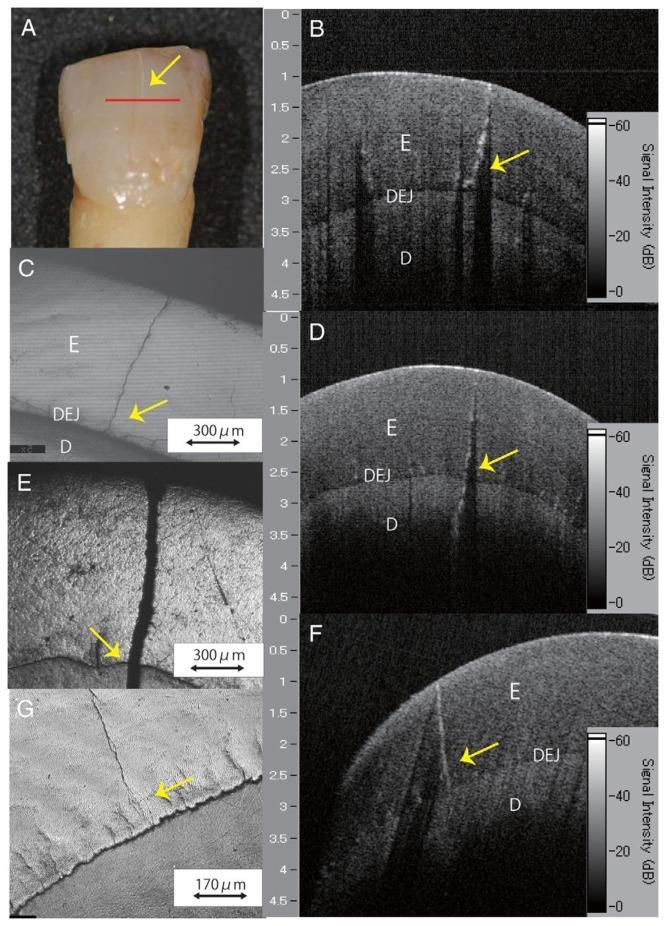 Οπτική Τομογραφία (Optical coherence tomography, OCT) Imai K., et al., J. Endod. 2012;38:1269 1274 (E: enamel; D: dentine; DEJ: dentin-enamel junction) Images of a distinct enamel crack.