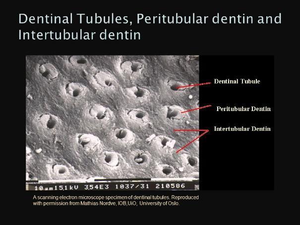 planes and possibly the depletion of intertubular dentine after laser application.