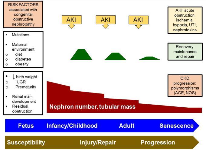 Factors contributing to congenital obstructive nephropathy and to