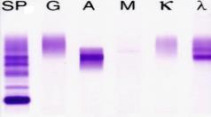 International Myeloma Working Group guidelines for serum-free light chain analysis in multiple