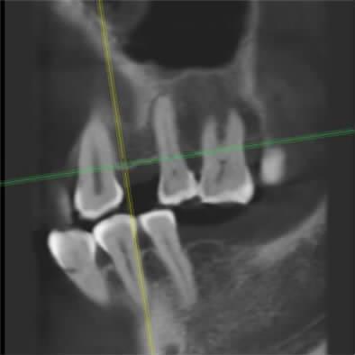 cancellous bone in the control area A B CT 0 500 0 200 400 600 800 1 000 (mg/cm³) 4 CT(CBCT) Figure 4 Linear regression fitting of
