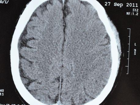 60 yo men, past MI, Paroxysmal AF