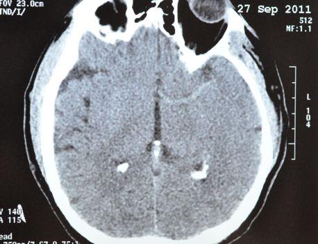 hemiplegia, global aphasia (NIHSS score