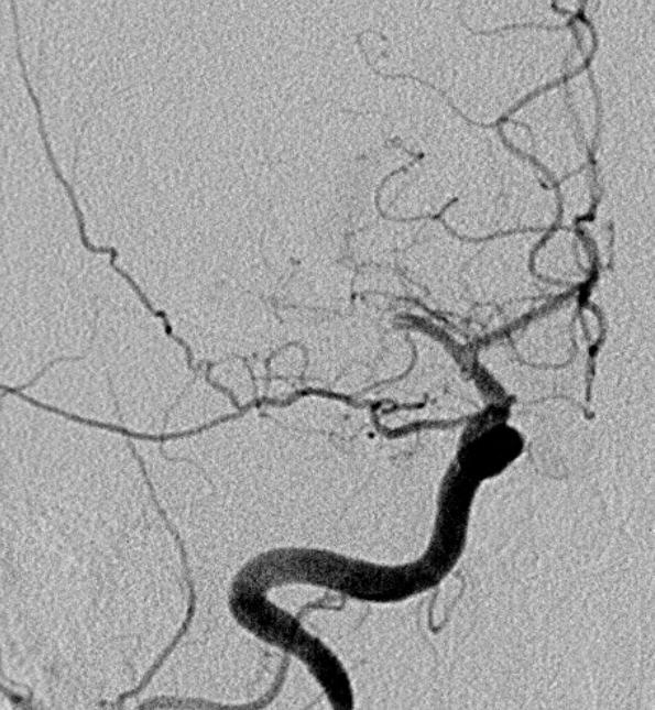 Intracranial