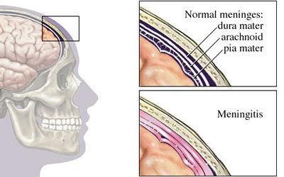 Meningitis Me i gitis je v etje ožga skih