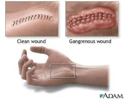Gangrena