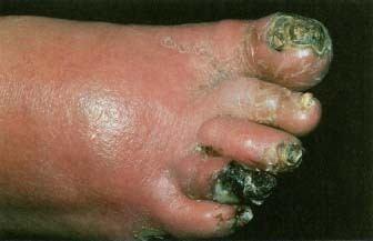 Gangrena