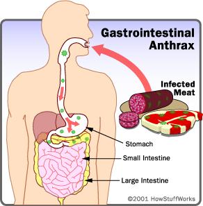 Antrax gastrointestinal