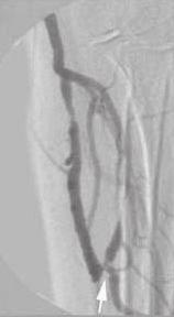 Стеноза вене артериовенске фистуле Сумње на клинички испољену стенозу