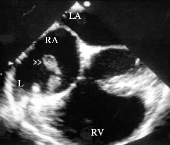 Sensitivity of TEE vs TTE in PM lead endocarditis Acute group (< 6 weeks) TEE sensitivity: 92% TTE sensitivity: 7% Chronic group (> 6 weeks) TEE sensitivity: 95% TTE sensitivity: 30% Klug D, et al.